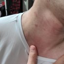 화이자1차 - 화이자 일주일 후 두통 부작용 후기 및 병원비