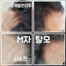 예뻐지는집이레 | M자 탈모에서 해방되기~