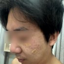 흑자 치료 후기 자연재생한의원 | 색소침착 잡티 개선 리얼 후기