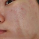 다빈레이저 | 수원피부관리 에스테틱 다리아 수원점 더포펙트 모공 타이트닝 레이저와 엑소 리페어 후케어 후기
