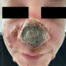 [예언성취 : 에이즈보다 무서운 전염병] 에이즈(HIV)와 매독으로 인해 면역 체계가 황폐화되어 코가 썩기 시작한 독일 원숭이두창 환자 이미지