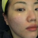 (주)마중솔루션 | 일산 여드름관리 솔에스테틱 일산점 문제성 여드름 흉터 관리후기