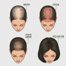 빛이난다의원 | 절개모발이식 뒷머리 흉터 얼마나 남나요 – 후기·부작용 현실 정리