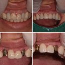만연치과기공소 | 자연스러운 앞니 임플란트 , 지르코니아 크라운 브릿지 뜯고 진행한 어두운색 안보이는 임플란트 치료 방법