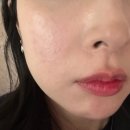 백피부과의원 | [부천역피부과 추천] 백피부과의원 피부과 전문의 진료로 접촉성피부염 좋아진 후기