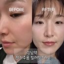 강남의원 | 강남 팔자주름필러 에르네의원 후기