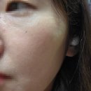 차차한의원 | 의정부 노원 한의원 기미 제거 치료 레이저 약침 통증 애브넘 3회차 후기