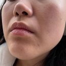 모든한의원 | 강남역 한의원 편평사마귀 1주차 제거 간지러움 후기