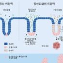 장상피화생 위암 전 단계 장상피화생 원인 증상 치료 이미지