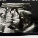 더세인트요양병원 | [임신19-20주차] 20주3일 세인트마리여성병원 정밀초음파 후기(+몸무게변화/배크기/태동 등)