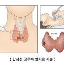 갑상선 고주파 열치료 시술 이미지