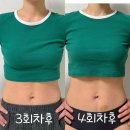 아이러브피부과의원 | 상상이 현실이되는 의원, 날씬한 허리라인을 상상하며 방문한 대전 복부지방분해주사 4회차 후기