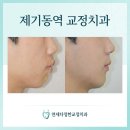 제기동역(1) | 제기동역 교정치과 제기동역치과 돌출입 들어간 후기