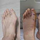 외금 | 최소침습 무지 외반증 수술 후 핀 빼기