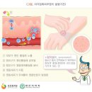 자극성 접촉 피부염과 알레르기성 접촉 피부염의 비교 이미지