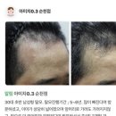 아미치 | 순천 탈모관리 후기｜아미치 0.3에서 두피·모근 관리 받아본 솔직 후기