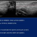 Inguinal canal hernia 이미지