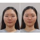 유명한의원 | 강남 안면비대칭한의원으로 유명한 심용섭십장생한의원 다녀온 솔직후기(Before/After 사진O)