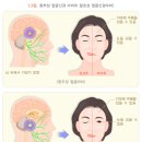 얼굴마비(말초성 마비) ＜질병관리청 국가정보포털＞ 이미지