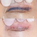 창원/마산 아이라인 문신제거 1~3회차 전후 과정 후기(통증, 붓기)