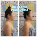 화성 JH윤곽술 후기 : &#39;뷰티를 디자인하다&#39;