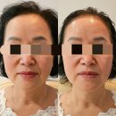 부산두피관리 디톡스로 완벽한 얼굴윤곽 후기 서면’다풀림뷰티랩’200%만족