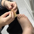 성정가야재활의학과의원 | 발목 전거비인대 완전파열 수술 재활,도수치료 후기 4