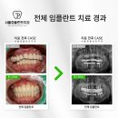 서울정플란트치과의원 | 서울정플란트치과 전체 임플란트 치료 경과