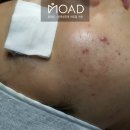연부볼트 | 20대 남자 볼 모낭염 붉은 자국, 짜낼수록 흉터만 깊어지는 진짜 이유 (건대 면도 트러블 복구 관리 후기)
