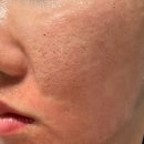 백피부과의원 | 강남피부과 앙코르레이저, 여드름흉터치료 1회 솔직후기!