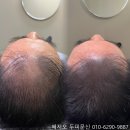 *****6026 | 남성 정수리 탈모 모발이식 대신 자연스러운 두피문신 커버후기