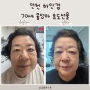 인천하안검 연수구성형외과 유명한곳 우리 엄마 리얼후기
