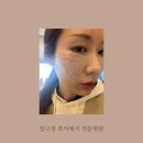 해피라움약국 | 압구정 흑자 제거 전문 병원 &#34;라움성형외과&#34; 방문!!!