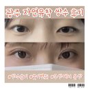 수 | 광주 자연유착 쌍커풀 수 후기(붓기변화&amp;회복과정)