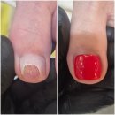 원트네일(want nail) | 발톱박리 복원｜젤페디 오래 방치 후 들린 발톱 레진 복원 후기Toenail Restoration After Nail Lifting