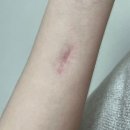 상무병원 | 광주상무병원 손목 엄지 수술 후 6개월차 후기