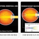 [밝은광주안과]리줌(ReZoom)렌즈 이미지