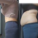 씨에스유통 (주) 복대점 | 복부지방흡입부작용 걱정했던 두달반차 후기 찜