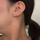 바로서면병원 (급식소포함) | [내 돈 내산] 부산 편평사마귀 제거 후기. (서면/전문의 피부과) 추천 가격. 관리법까지.