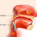 가래, 헛기침, 코막힘이 동반되는 후비루 증후군 증상과 원인 치료 방법 이미지