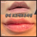 예산미소천사의원 | [홍대] 프로젝트유의원｜자연스러운 입술필러｜ 전후사진｜붓기, 통증 등 내돈내산 시술 찐후기