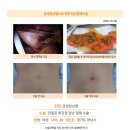 급성담낭염수술후기. 1년씩 받는 건강검진에서 너무 심하다 하시고 증상도 계속되어 수술하기로 하였습니다. 이미지