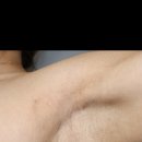 포레성형외과의원 | 정말 겨드랑이 흉터 신경쓰인다면 포레성형외과~