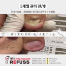 네일포시즌 레푸스 합정점 | [레푸스 남포점] 무좀손톱, 물어뜯는손톱, 문제성손톱 관리 어떻게 하나요? 5개월 관리 후기!