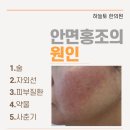 동서통합한의원 | 용인안면홍조 한방관리로 편안하게 가꾸는 피부