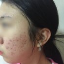 여드름전문한의원과 피부과 흉터 치료 둘다 경험한 후기