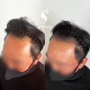 홍대두피문신 당산두피문신 smp수강 아카데미 - 새로이숲 합정점