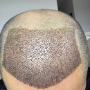 티이씨 (Total Eye Care) | Korean hair transplant review from Turkey!