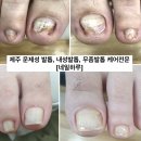 문제성 손발톱 전문관리 케어톱톱