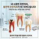 [동천역 신경치료] 아프지 않은 50대 자연치아 살리기 성공후기